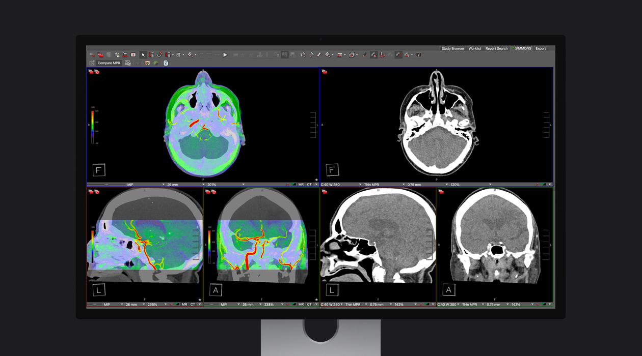 CT of a person's head with and without color